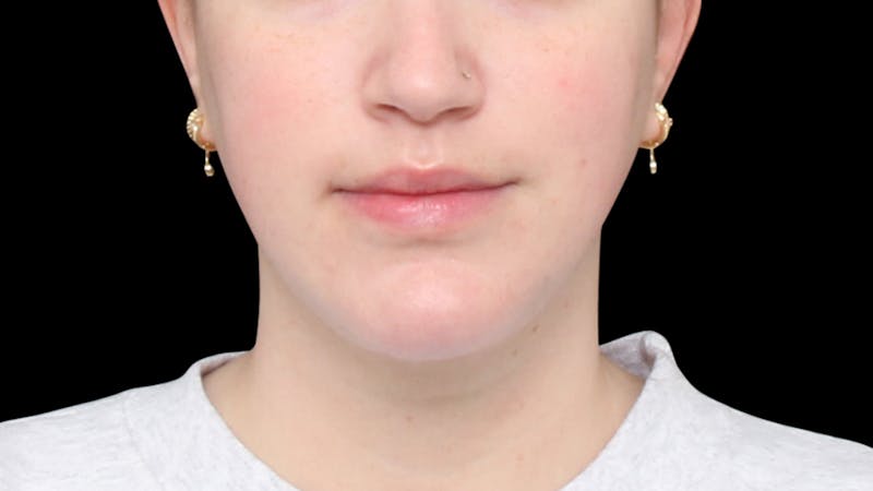 Chin Liposuction Before & After Gallery - Patient 396350 - Image 9