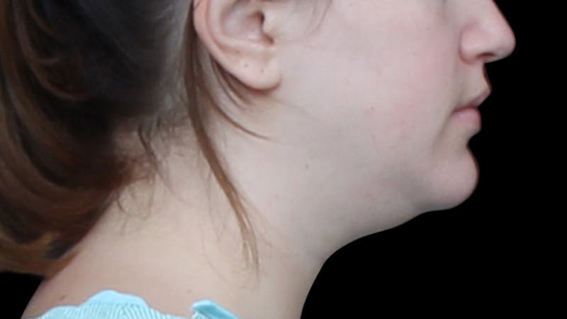 Chin Liposuction Before & After Gallery - Patient 396350 - Image 7