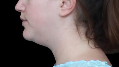 Chin Liposuction Before & After Gallery - Patient 396350 - Image 1