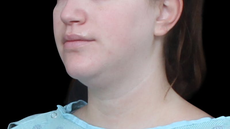Chin Liposuction Before & After Gallery - Patient 396350 - Image 3
