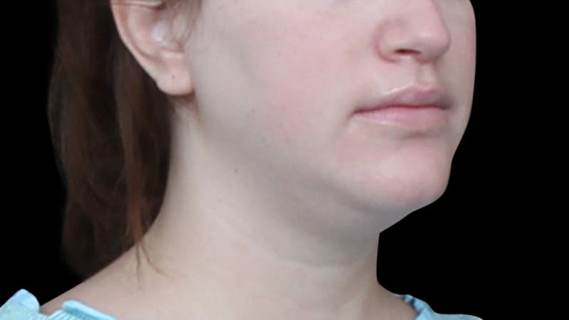 Chin Liposuction Before & After Gallery - Patient 396350 - Image 5