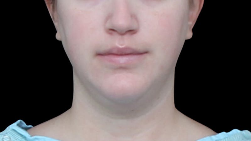 Chin Liposuction Before & After Gallery - Patient 396350 - Image 10
