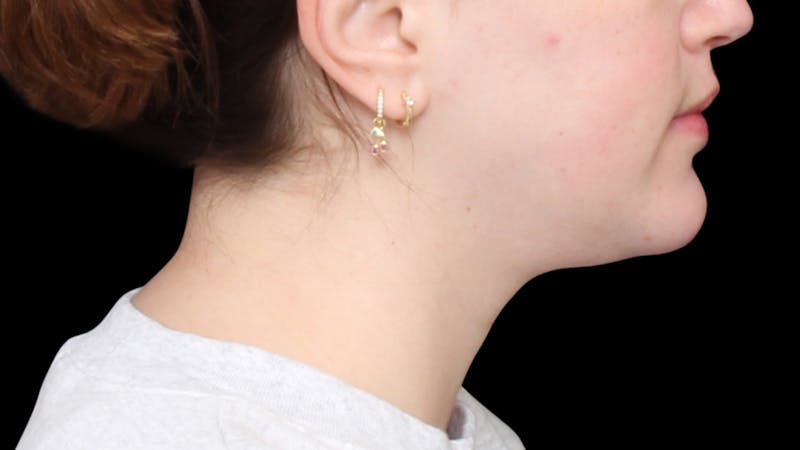 Chin Liposuction Before & After Gallery - Patient 396350 - Image 8