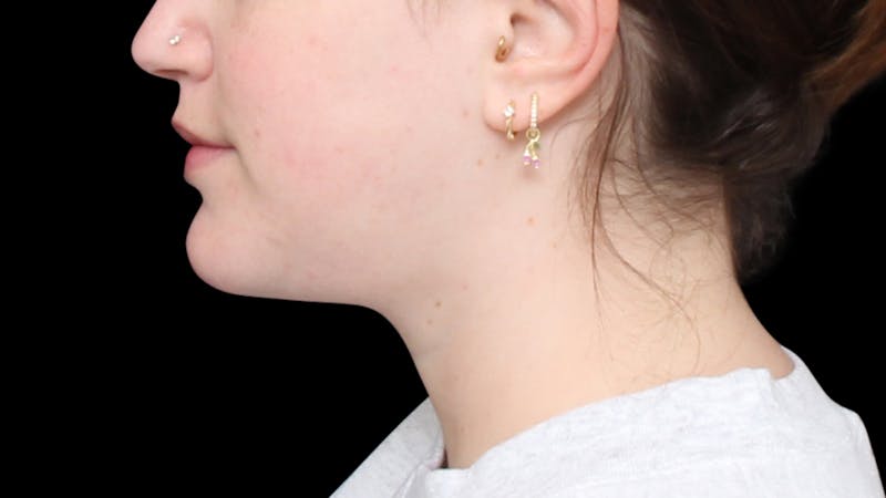 Chin Liposuction Before & After Gallery - Patient 396350 - Image 2