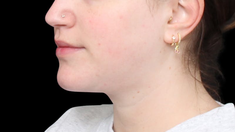 Chin Liposuction Before & After Gallery - Patient 396350 - Image 4