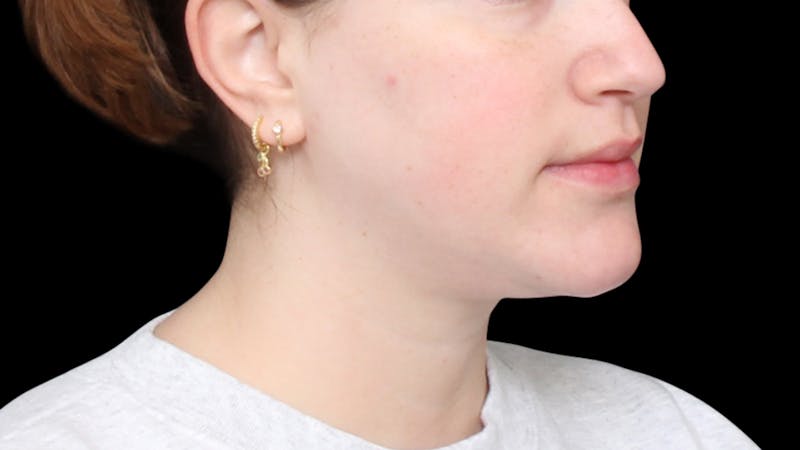 Chin Liposuction Before & After Gallery - Patient 396350 - Image 6
