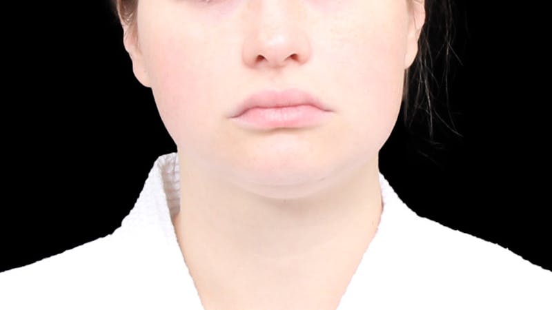 Chin Liposuction Before & After Gallery - Patient 429475 - Image 9