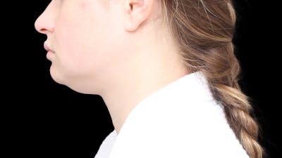 Chin Liposuction Before & After Gallery - Patient 429475 - Image 1