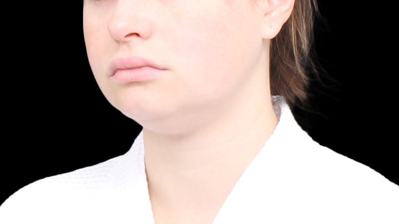 Chin Liposuction Before & After Gallery - Patient 429475 - Image 3