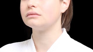 Chin Liposuction Before & After Gallery - Patient 429475 - Image 4