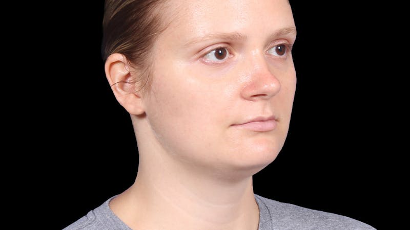 Chin Liposuction Before & After Gallery - Patient 165729 - Image 3