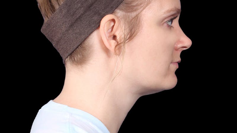 Chin Liposuction Before & After Gallery - Patient 165729 - Image 8