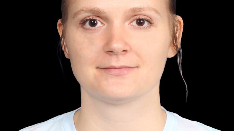Chin Liposuction Before & After Gallery - Patient 165729 - Image 10