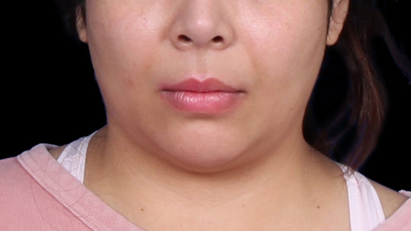 Chin Liposuction Before & After Gallery - Patient 921069 - Image 9