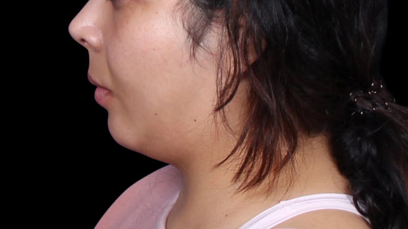 Chin Liposuction Before & After Gallery - Patient 921069 - Image 1