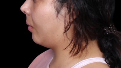 Chin Liposuction Before & After Gallery - Patient 921069 - Image 1