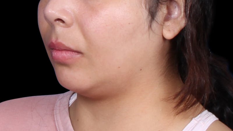 Chin Liposuction Before & After Gallery - Patient 921069 - Image 3
