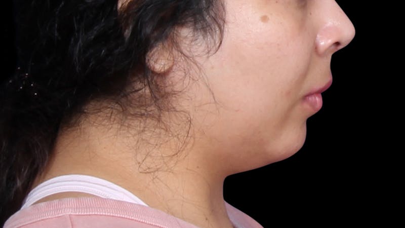 Chin Liposuction Before & After Gallery - Patient 921069 - Image 5