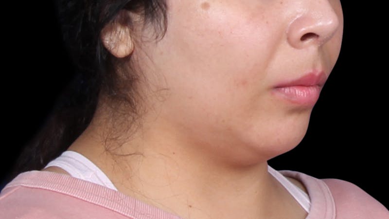 Chin Liposuction Before & After Gallery - Patient 921069 - Image 7