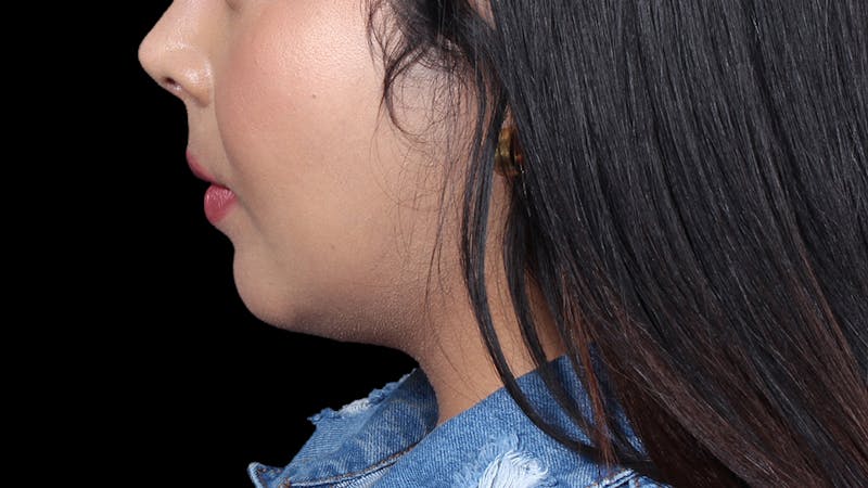 Chin Liposuction Before & After Gallery - Patient 921069 - Image 2