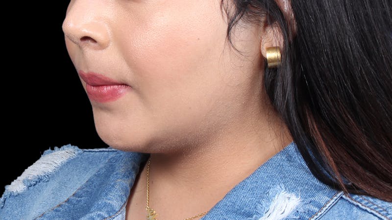 Chin Liposuction Before & After Gallery - Patient 921069 - Image 4