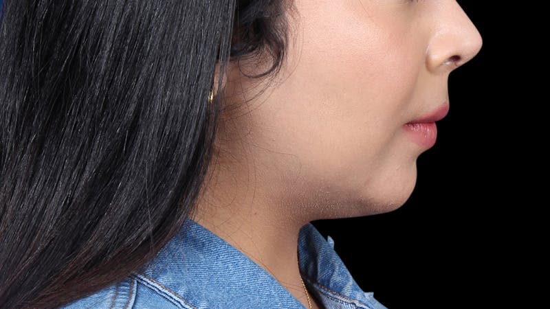 Chin Liposuction Before & After Gallery - Patient 921069 - Image 6