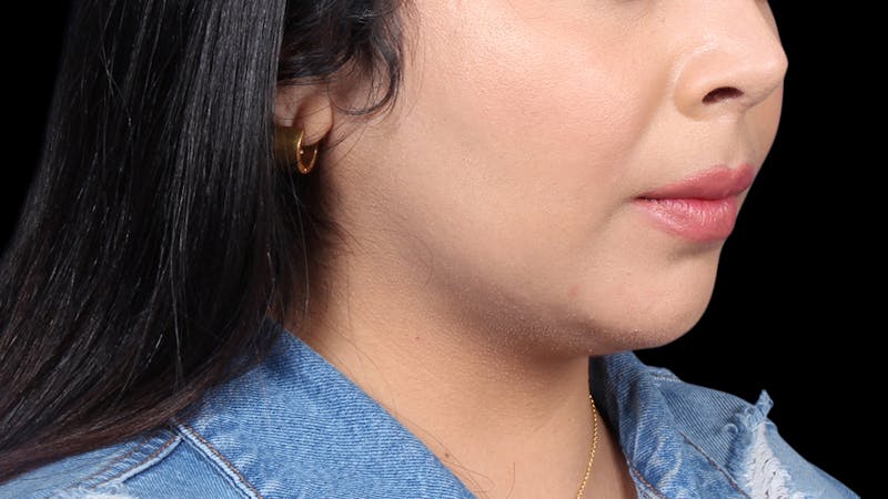 Chin Liposuction Before & After Gallery - Patient 921069 - Image 8