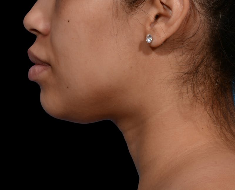 Chin Liposuction Before & After Gallery - Patient 299600 - Image 1