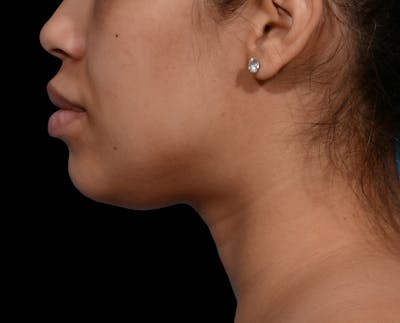 Chin Liposuction Before & After Gallery - Patient 299600 - Image 1
