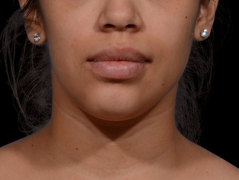 Chin Liposuction Before & After Gallery - Patient 299600 - Image 5