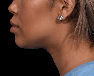 Chin Liposuction Before & After Gallery - Patient 299600 - Image 2