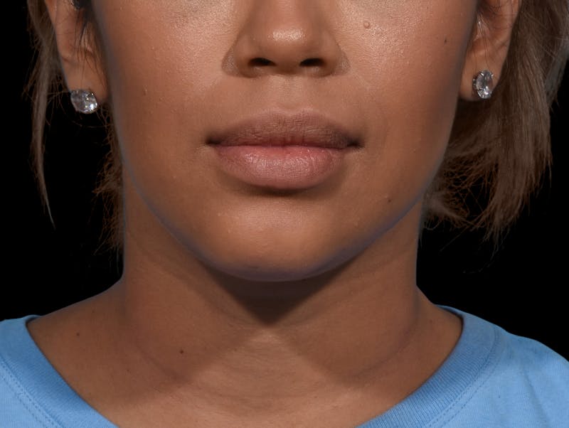 Chin Liposuction Before & After Gallery - Patient 299600 - Image 6