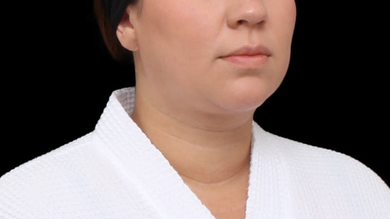 Chin Liposuction Before & After Gallery - Patient 254106 - Image 8