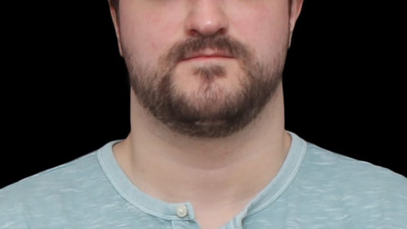 Chin Liposuction Before & After Gallery - Patient 227676 - Image 10