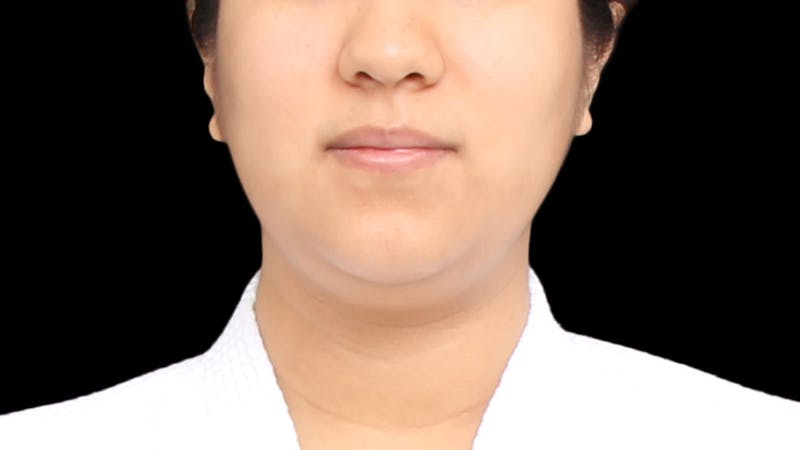 Chin Liposuction Before & After Gallery - Patient 405562 - Image 9