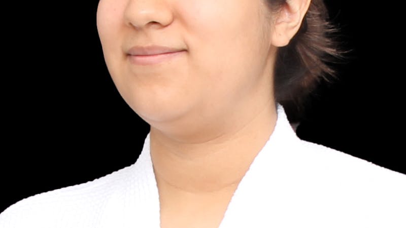 Chin Liposuction Before & After Gallery - Patient 405562 - Image 3