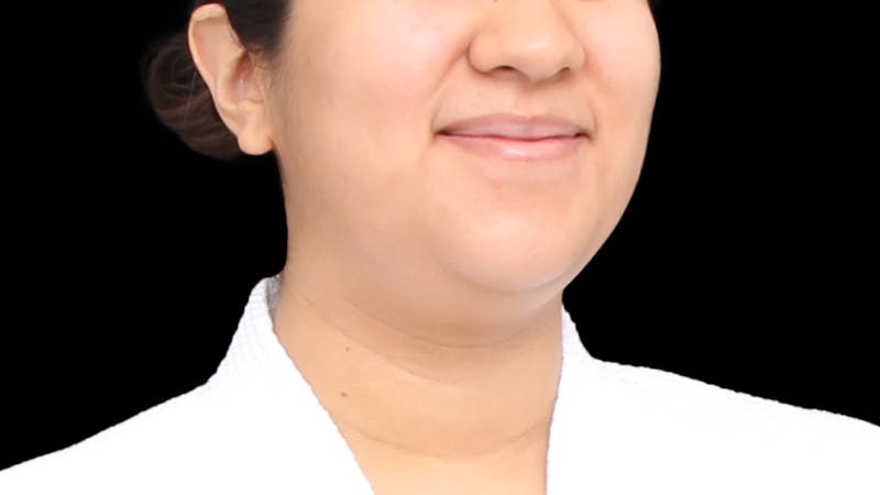 Chin Liposuction Before & After Gallery - Patient 405562 - Image 5