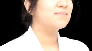 Chin Liposuction Before & After Gallery - Patient 405562 - Image 6