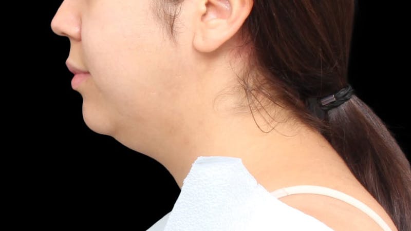 Chin Liposuction Before & After Gallery - Patient 352877 - Image 1