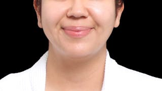 Chin Liposuction Before & After Gallery - Patient 352877 - Image 10