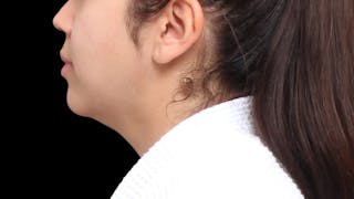 Chin Liposuction Before & After Gallery - Patient 352877 - Image 2