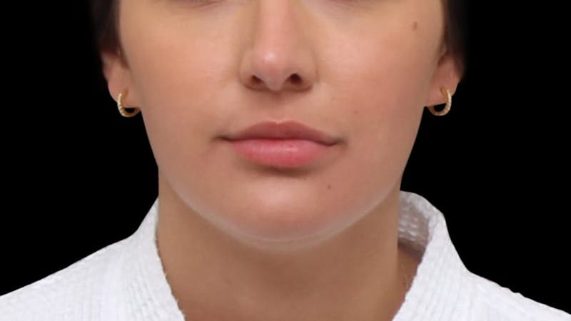 Chin Liposuction Before & After Gallery - Patient 618759 - Image 9