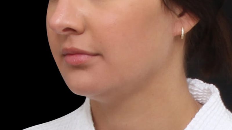 Chin Liposuction Before & After Gallery - Patient 618759 - Image 3