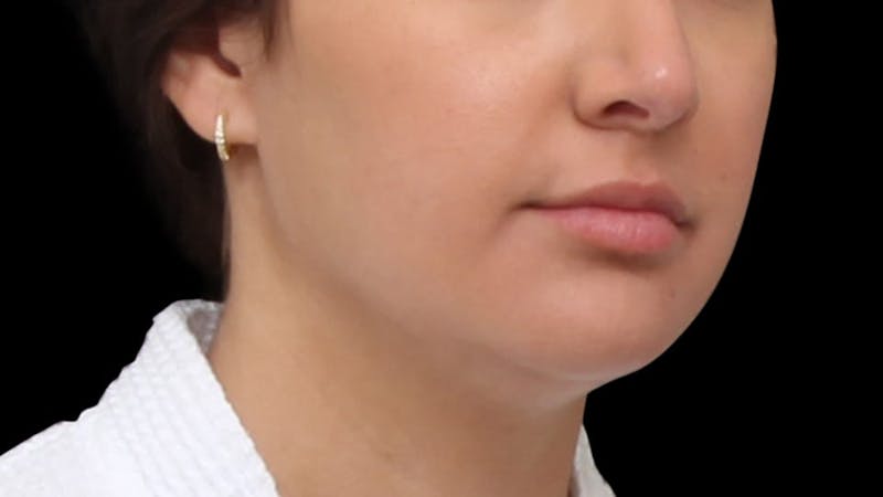 Chin Liposuction Before & After Gallery - Patient 618759 - Image 7