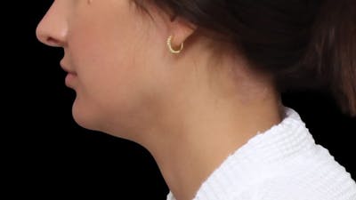 Chin Liposuction Before & After Gallery - Patient 618759 - Image 1