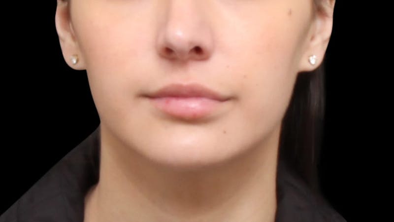 Chin Liposuction Before & After Gallery - Patient 618759 - Image 10