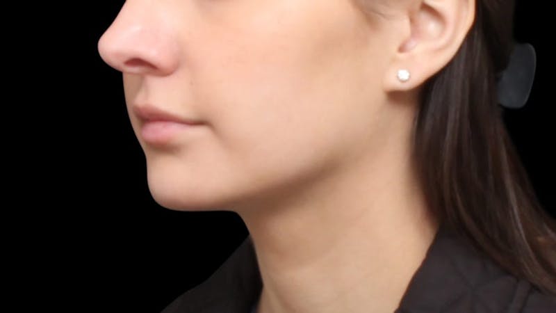 Chin Liposuction Before & After Gallery - Patient 618759 - Image 4