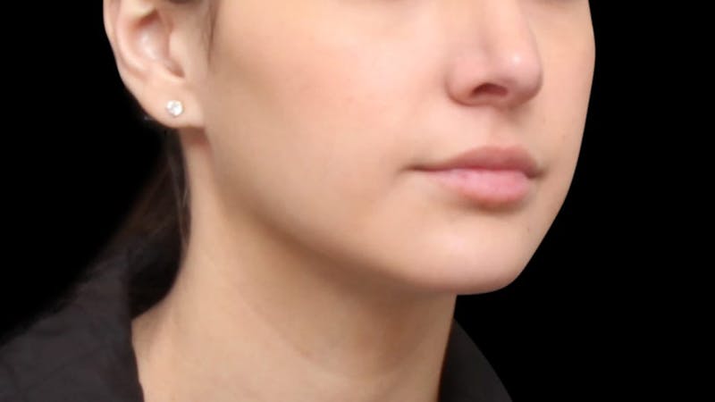 Chin Liposuction Before & After Gallery - Patient 618759 - Image 8