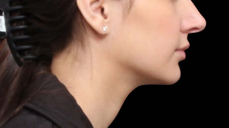 Chin Liposuction Before & After Gallery - Patient 618759 - Image 6