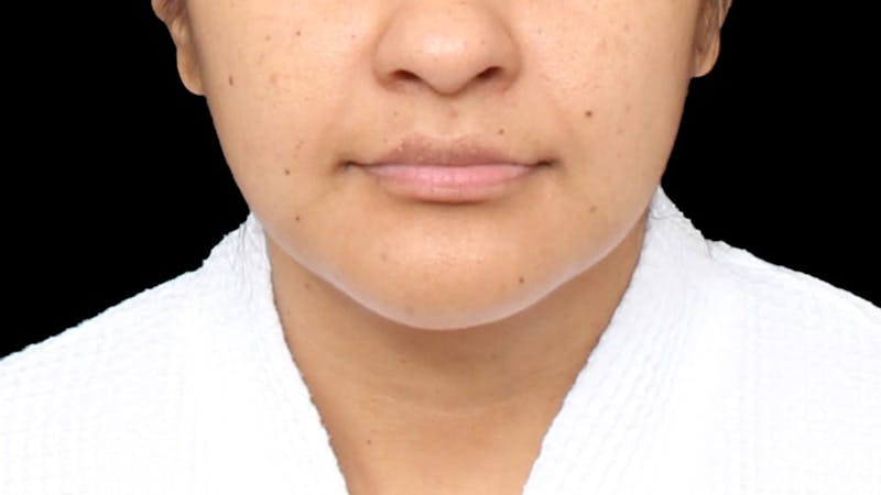 Chin Liposuction Before & After Gallery - Patient 313835 - Image 9